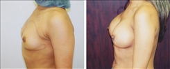 Breast Augmentation Patient Before & After Photo 1