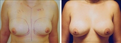 Breast Augmentation Patient Before & After Photo 1