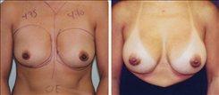 Breast Augmentation Patient Before & After Photo 1