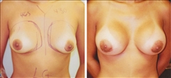 Breast Augmentation Patient Before & After Photo 1