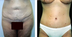 Before & After Panniculectomy Photos