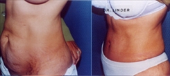 Before & After Panniculectomy Photos