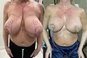 Reasons for Breast Reduction Surgery