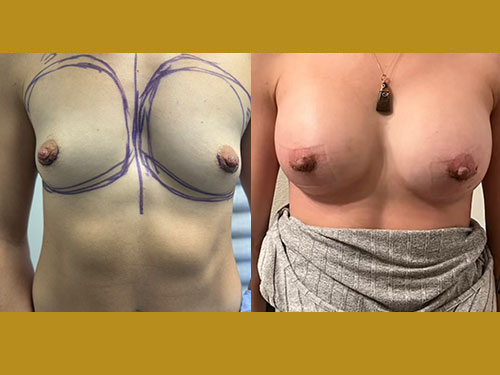 Breast Augmentation Patient Before & After Photo 1