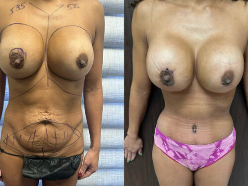 Breast Implant Revision Patient Before & After Photo 1