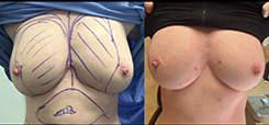 Fat Transfer to the Breast Patient Before & After Photo 1