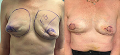 Fat Transfer to the Breast Patient Before & After Photo 1